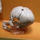 Image for article titled Why would you want someone to drill a hole in your skull?